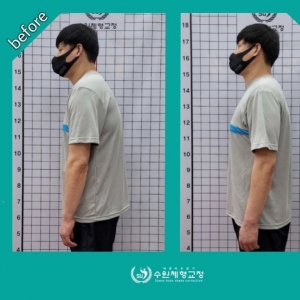 [수원/영통구] 수원체형교정