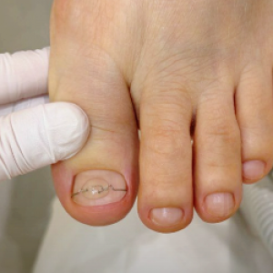 [대전/서구] 레푸스 대전도안점 (내성발톱관리)