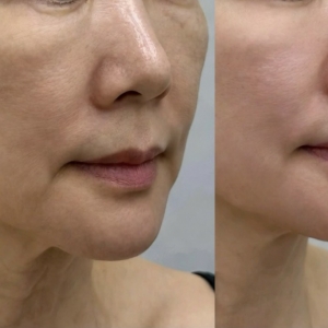 [경남/창원시] 뷰티밤 (리프팅케어)